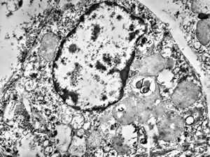 M,5m. | intracellular cholestasis - atresia of biliary ducts